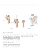 Versanail® Humeral Proximal Nailing System Product Rationale & Surgical Technique - 11