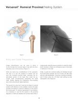 Versanail® Humeral Proximal Nailing System Product Rationale & Surgical Technique - 12