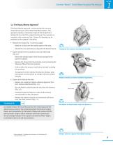 Zimmer® Nexel™ Total Elbow Surgical Technique-9