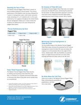 Zimmer® NexGen® Precoat Pegged Tibial Plate - 2