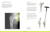 Ovation® Surgical Technique-4