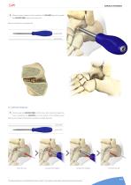 Cannulated (subtalar) screw-9