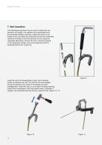 Tibia IM Nail-10