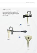 Tibia IM Nail-13