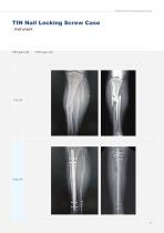 Tibia IM Nail-7
