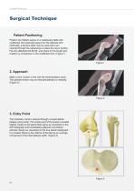 Tibia IM Nail-8
