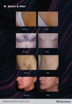Winkonlaser AresLite® DL1000A 2 Handles laser hair removal Machine-6