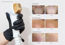 Winkonlaser Aressmart® DL500 laser hair removal Machine-5