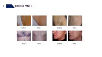 Winkonlaser DL700 2 Handles laser hair removal Machine-8