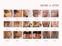 Winkonlaser HU700 4-in-1 5D HIFU Desktop Machine Face Lifting Body Slimming Vaginal Tightening-11