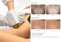 Winkonlaser VL10 LED Hair Removal Machine-6