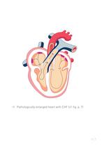 Congestive Heart Failure Therapy System - 9