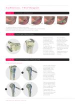 ALIANS PROXIMAL HUMERUS - 4