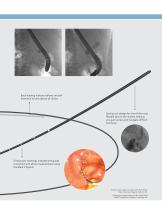 Acrobat™ Calibrated Tip Wire Guide - 4