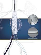 Beacon® Tip Van Schie Seeking Catheters - 2