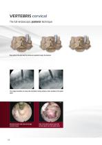 VERTEBRIS cervical Brochure - 8