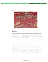 Endovenous Ablation-3