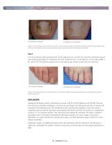 Treatment of Onychomycosis* with the JOULE® ClearSense?-3