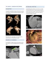 Left Atrial Appendage white paper-3