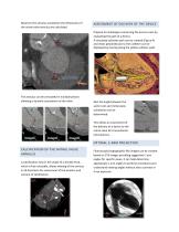 WHITE PAPER Mitral valve assessment based on MSCT imaging yields useful information regarding mitral valve anatomy and function - 2