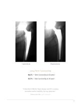 CORAIL® Hip System Design Rationale - 5