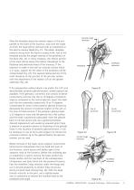 GLOBAL Advantage Surgical Technique - 11