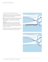 LCP Distal Ulna - 10