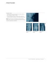 LCP Distal Ulna - 7