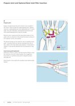 LCP Wrist Fusion - 10