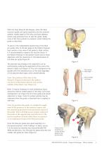 TruMatch Pin Guides - 5