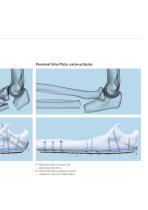 VA-LCP Elbow Plating System Promotional - 9