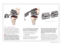 Unity knee surgical technique - 11