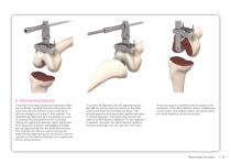 Unity knee surgical technique - 9