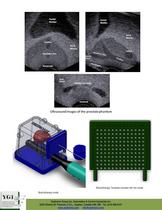 YEZITRONIX Brachytherapy Prostate without catheter Phantom Model - 2