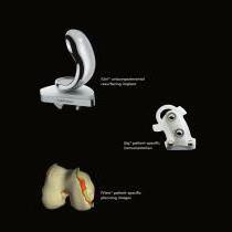iUniG2 Patient-specific unicompart mental knee resurfacing system-3