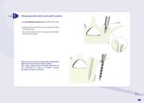 Easyspine®-3
