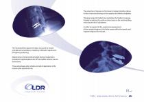 MOBILE BEARING ARTIFICIAL DISC TECHNOLOGY-3