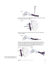 Articulating SIDEKICK® CORETRAK® Surgical Technique ? FA144?309 - 10