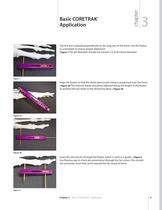 Articulating SIDEKICK® CORETRAK® Surgical Technique ? FA144?309 - 6