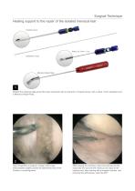 Applications of ACP* in knee surgery Surgical Technique - 7