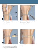 Subpectoral Biceps Tenodesis using Cortical Buttons - 5