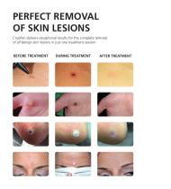 CryoPen - Medical Brochure - 4