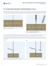 Mecron® Cannulated Screw System and Chronoceptor™ - 10