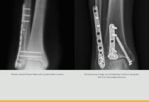 Ankle Plating System 3 Brochure (LEX40-05-F)-10