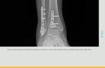Ankle Plating System 3 Brochure (LEX40-05-F)-11