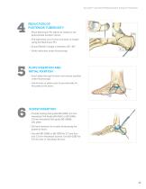 Calcaneal Plating System Surgical Technique (LEX00-05-E)-11