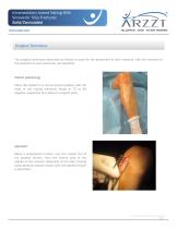 Intramedullary Locked Nailing With Screws for Tibia Fractures-13