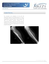Intramedullary Locked Nailing With Screws for Tibia Fractures-9