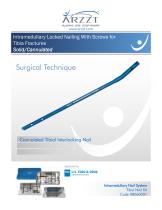 Intramedullary Locked Nailing With Screws for Tibia Fractures