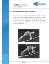 Intramedullary Nail for Humerus-13